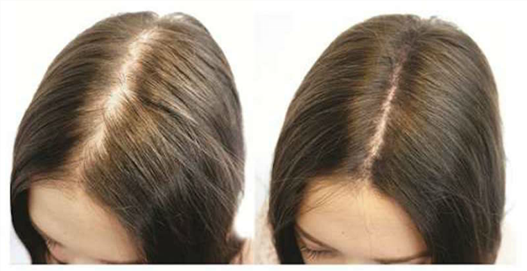 Types of Disease That Cause Hair Loss Manhattan, NYC - The Hair