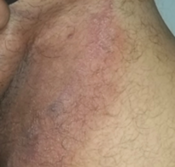 Jock Itch (Tinea Cruris) Condition, Treatments and Pictures for