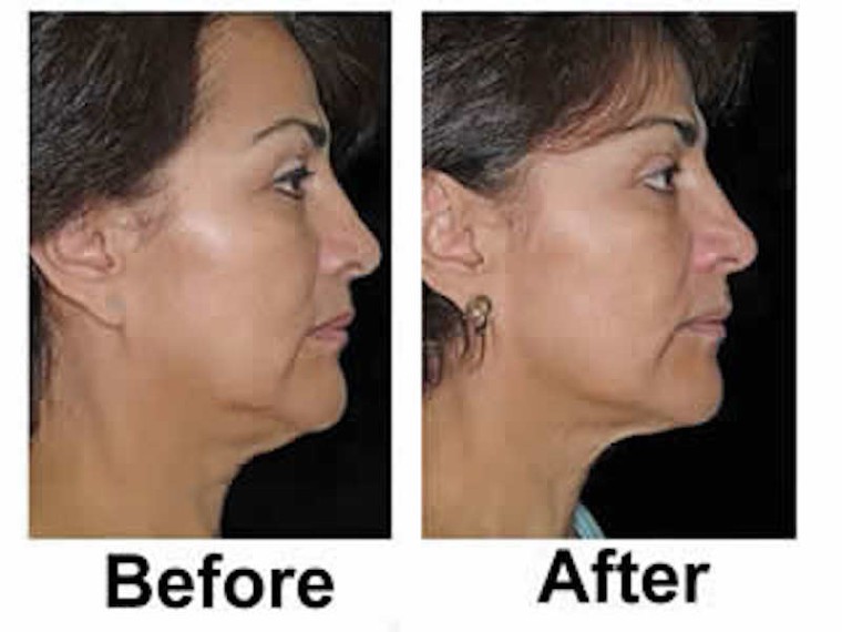 Non-Surgical Skin Tightening NYC - NYC Non-Surgical Skin