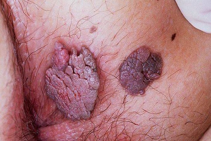 genital warts testicles