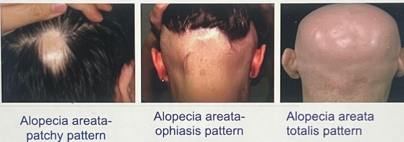 alopecia areata treatment injection